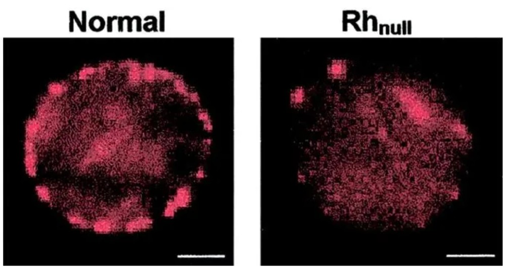 L'immagine confronta la struttura di un globulo rosso normale con uno affetto da fenotipo Rhnull. A sinistra, la cellula "Normal" mostra una distribuzione regolare e ben definita del segnale fluorescente lungo il bordo membranoso. A destra, il fenotipo "Rhnull" evidenzia un'organizzazione alterata, irregolare e frammentata della membrana cellulare.